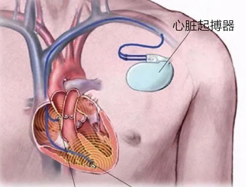 政策解读 | 进口心脏起搏器有哪些监管要求？